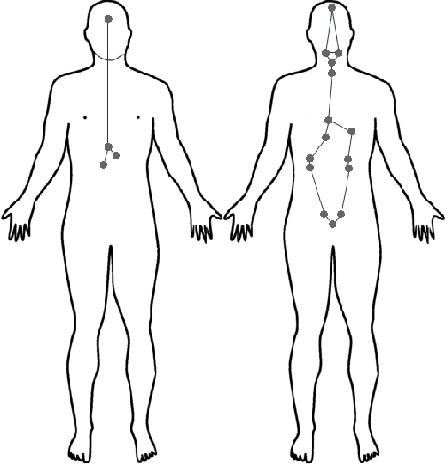 Treating High Blood Pressure Holistically with Hijama WET Cupping